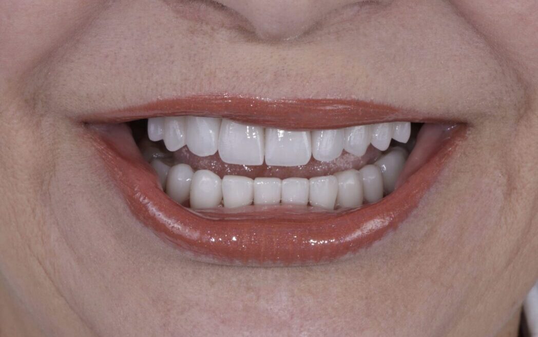 Age-Related Wear Corrected with Comprehensive Aesthetic Dentistry.